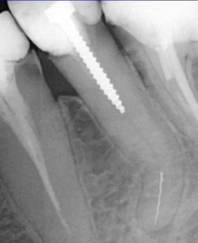 gabry5 - Cóż... Nie wszystkie zęby da się uratować, ale próbować warto. 
#stomatologi...