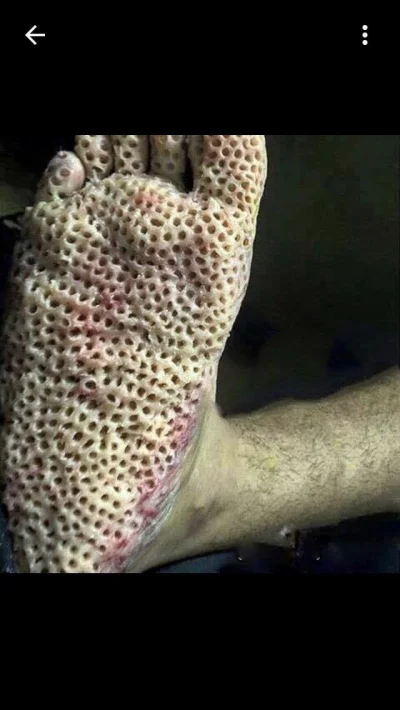 Hav0c - Robię nitkę z najlepszymi obrazkami z #trypophobia ( ͡° ͜ʖ ͡°)

Zaczynam: