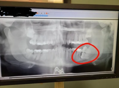 Kosciany - #xray #medycyna #stomatologia #dentysta