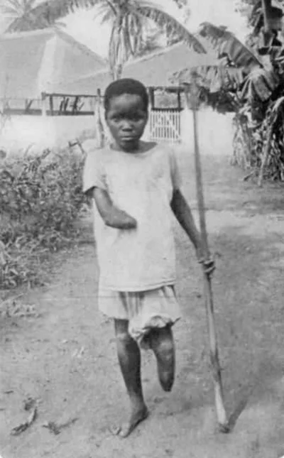 b.....r - Dziecko pokazuje swoje odcięte kończyny misjonarzom w Kongu Belgijskim w 19...