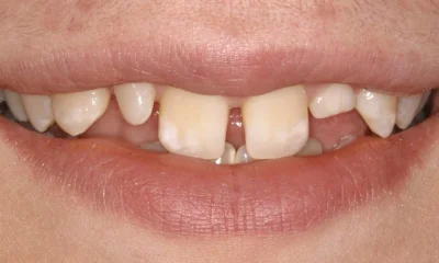 cynamonowazaslona - jest tu jakiś ortodonta powie co moge zrobić z zębami maksymalnie...