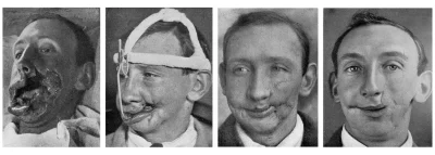 myrmekochoria - Rekonstrukcja twarzy brytyjskiego żołnierza, który został ranny pod S...
