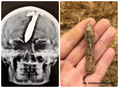 Zwiadowca_Historii - Niecodzienny artefakt z pola bitwy - czaszka mężczyzny w wieku 3...