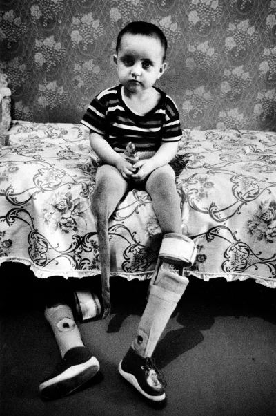 myrmekochoria - Dziewczynka z amputowanymi nogami, które straciła podczas ataku rakie...
