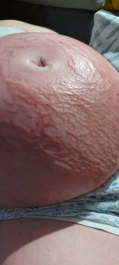 jmuhha - Alergia skóry u pacjentki w ciazy

#medyczneobrazki #ciaza