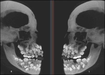 Kosciany - Hyperdontia is the condition of having supernumerary teeth, or teeth that ...