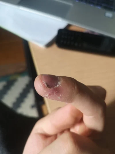 Podlaski_warmianin - wbił mi się kawałek drewna pod paznokieć, przy próbie wciągnięci...