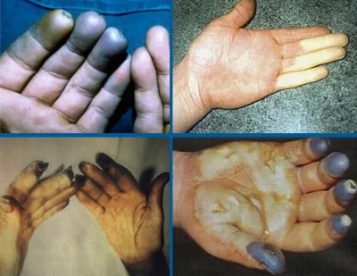Tranzystor_IGBT - Zdjecie przedstawia uszkodzenia dłoni spowodowane długotrwalym użyt...