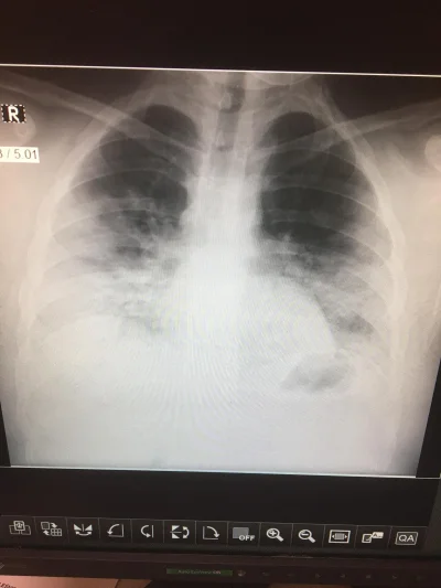 martinosv - Znajoma pracuje na radiologii od wielu lat i mówi, że tak zniszczonych pł...