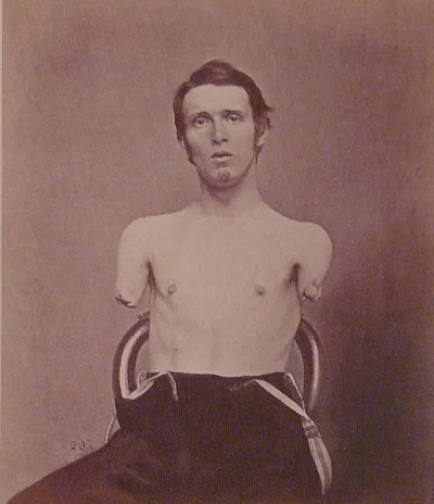 myrmekochoria - Alfred A. Stratton (1844- 1874). Weteran wojny secesyjnej ranny pod P...