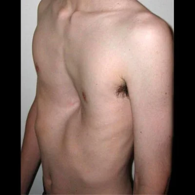 GUCIOScottishCat - Poszukuję osób z podobną deformacją klatki piersiowej. Może jest n...