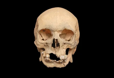 IMPERIUMROMANUM - Antyczna czaszka 35-letniego ze zrośniętymi szczękami

Znaleziona...