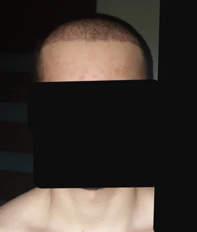 s0ngo_ - Heja, wrzucam update włosów po przeszczepie w Turcji (3 tydzień po).
-głowa...