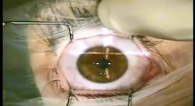 cheeseandonion - Zabieg laserowej korekcji wzroku

#medycyna #wzrok #korekcjawzroku