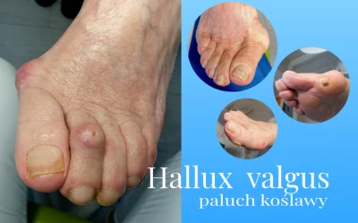 pawel86 - Amadeusz "Hallux Valgus" Roślik
#fammma #fame