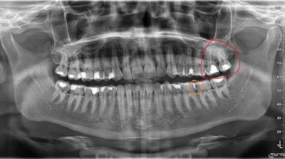 tyrystor_TO220 - #dentysta #stomatologia #rtg
Mirki, zrobiłem sobie zdjęcie pantomog...