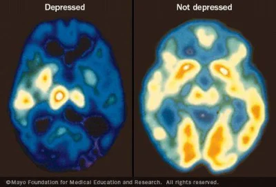 biesy - Porównanie mózgu człowieka z depresją i zdrowej osoby.

Ten skan PET pokazu...