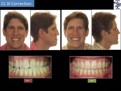 MarteenVaanThomm - @ymkzz: tu masz przykład korekcji wady klasy III invisalignem (tyl...