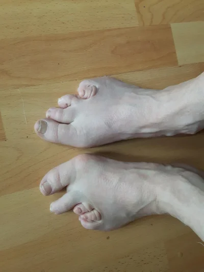 cheeseandonion - >Female, 60's, toes have apparently always been like that.

https:...
