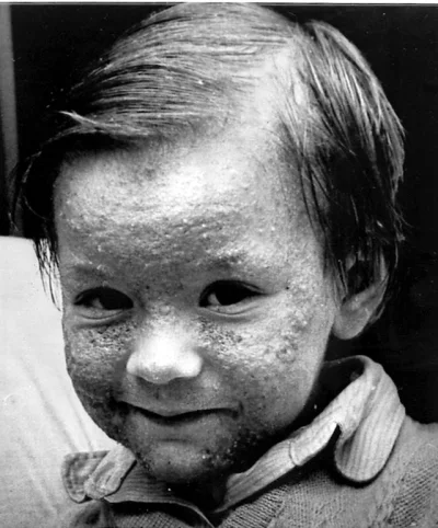 myrmekochoria - Dziecko z trądzikiem chlorowym po katastrofie chemicznej w Seveso, Wł...