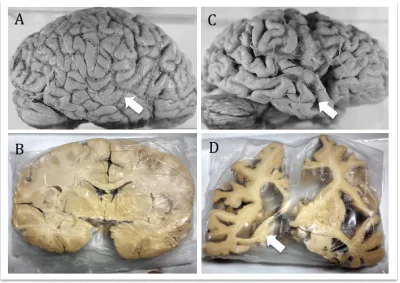 cheeseandonion - >Neuroanatomical comparison of normal brain and Alzheimer´s disease ...