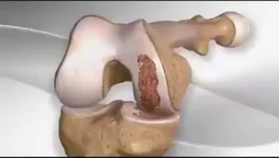 cheeseandonion - >This is how a partial knee replacement is done

#gifmedyczny #kolan...