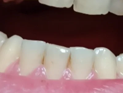 dasseltiG - Psują mi się zęby w ten sposób, jak to uratować?

#dentysta #zeby