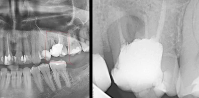 hurrdurr221 - Czy na zdjęciu, ząb 25, który był wyleczony kanałowo, jest poprawnie na...