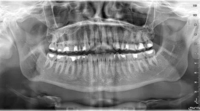 tyrystor_TO220 - #stomatologia #dentysta #endodoncja
Czy ząb 36 (prawy dół), który b...