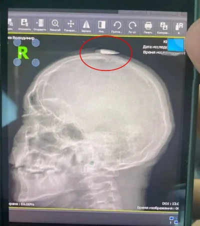 PIGMALION - #ukraina #rosja #wojna #medycyna

 Prześwietlenie głowy ukraińskiego żołn...