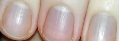 HumanBeing - To normalne że paznokcie mają taką strukturę z idącymi pionowo liniami?
...
