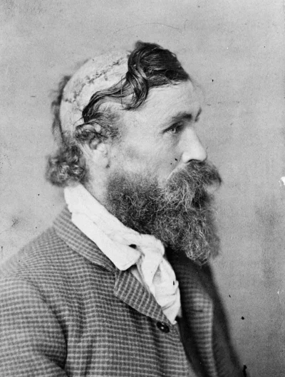 cheeseandonion - >Robert McGee, scalped as a child by Sioux Indians. 1890.

SPOILER...