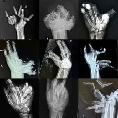 balatka - #sylwester2022 #medycyna #ciekawostki
tak wygląda rentgen dłoni po wybuchu ...
