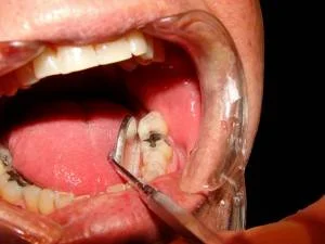 LorneMalvo - Ktoś z was jeszcze się buja z fatalny stan #zeby #dentysta glównie ze wz...