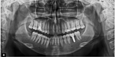 AnonimoweMirkoWyznania - #anonimowemirkowyznania 
Mirki czy na sali jest #dentysta ? ...