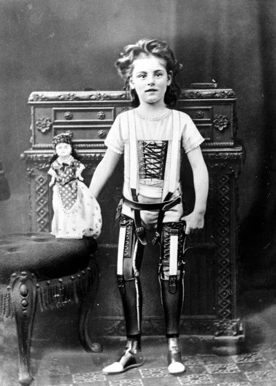 myrmekochoria - Dziewczynka z protezami wykonanymi przez Jamesa Gillinghama, Anglia p...