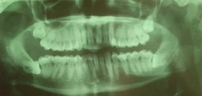 Ambiwalentnik - szukam kogos kto zna się na ocenie zdjęć rtg pantomograficznych zębów...