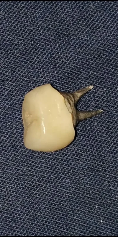 michael785 - Czy ktoś wie jak taka proteza zębowa się nazywa? Dentysta wkleił ją w Ko...