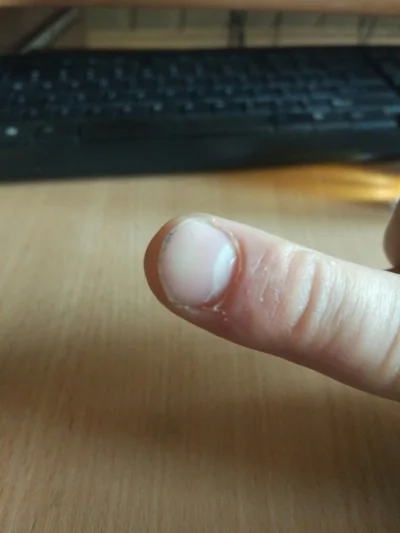 bonifacy_pankracy - Mam czarny punkt na paznokciu, powinienem iść do lekarza?