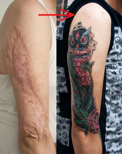 deryt - > nie jestem pewien czy grzebanie przy bliznach chocby poprzez tatuaz jest ro...