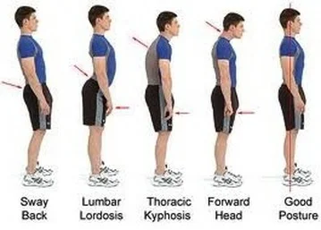 f423r - @mar0uk: Lumbar Lordosis