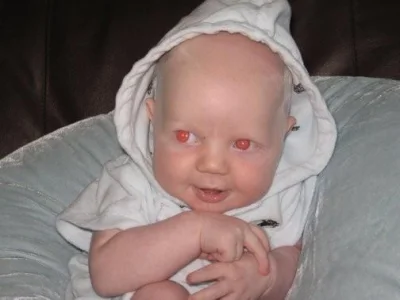 hahacz - Albinosi powinni mieć najczesciej czerwone oczy, dlaczego ci nie maja?