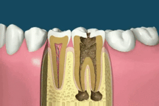 F.....x - #gif #dentysta #zab Oglądanie powoduje dreszcze.