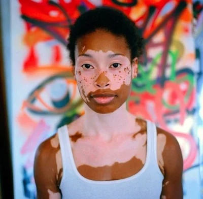 pogop - Bielactwo nabyte (łac. vitiligo) – przewlekła choroba polegająca na depigment...