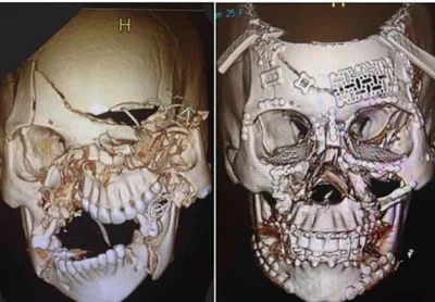 cerastes - Na obrazie z tomografu czaszka 25-letniej pacjentki, ofiary wypadku samoch...