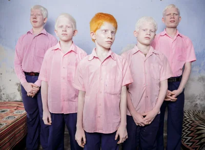 siRcatcha - #ciekawostki #nauka #biologia #albinizm #ludzie

Zdjęcie piątki niewidomy...