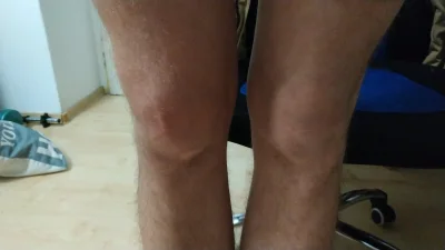 ArTeM6322 - Znowu mi kolano naszło wodą.. 2 razy większe od drugiego (to po lewej str...