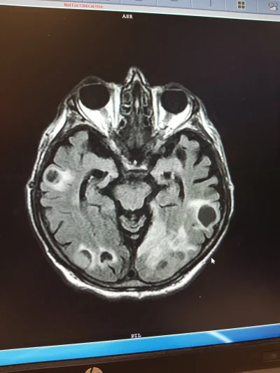 m.....2 - #medycyna #neurologia #sor

Wągrzyca mózgu. Facet trafił na SOR z powodu za...