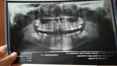 hazadSK - Hej Mirki. Otrzymalem od dentysty zalecenie bym zrobil przeswietlenie po ka...