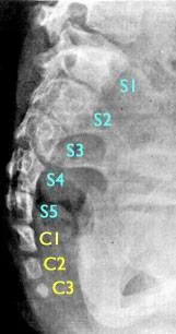 bioslawek - Dodatkowe kręgi w kości ogonowej, które nie uległy absorpcji i fagocytozi...